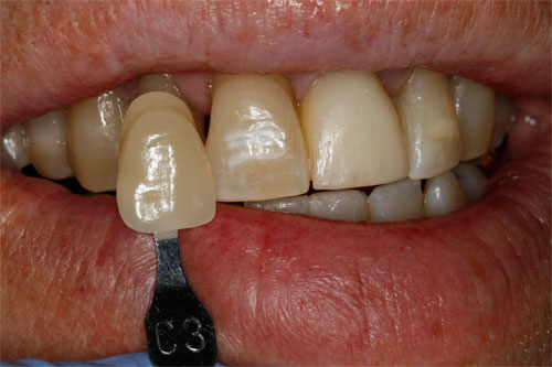 custom abutment and cement retained emax 2