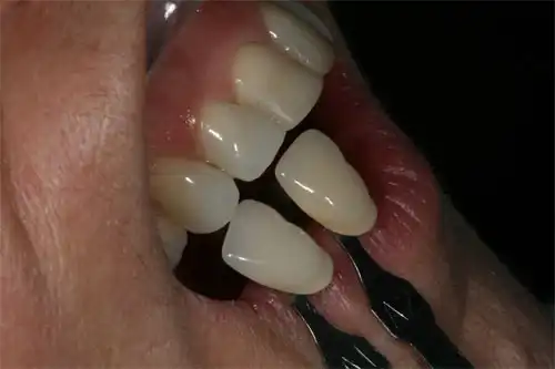 Close up of teeth side profile with shade matches