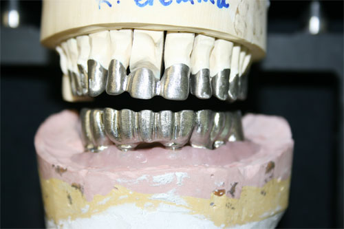 pfm screw retained implant 1