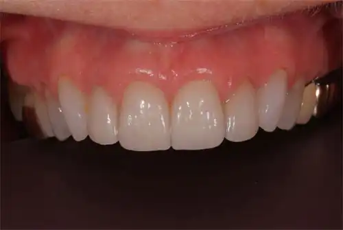 Close up of upper set of teeth